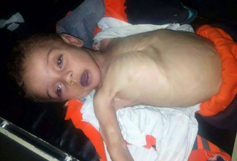 محمد ودياب، شهيدان نتيجة الجوع وقلة الأدوية في غوطة دمشق الشرقية
